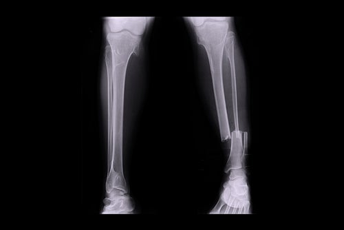 Healing broken bones with Microsoft Dynamics 365
