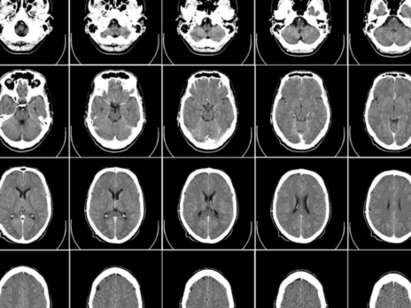 AI-generated brain scans highlight potential for synthetic healthcare data
